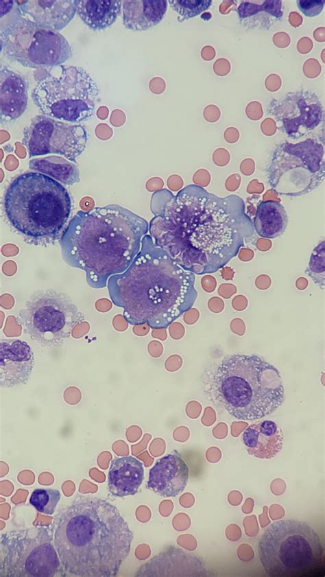 uterine cancer cells   peritoneal fluid rmedlabprofessionals