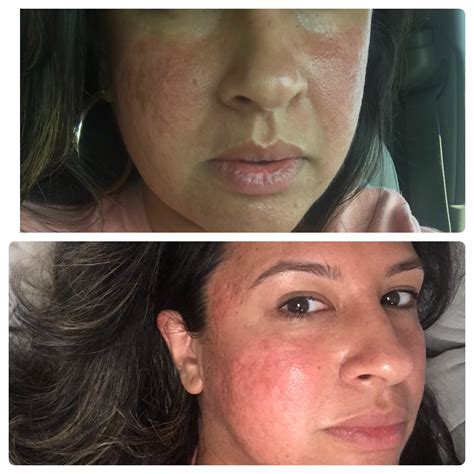 1st Session Of Microneedling To Treat Acne Scars Racne