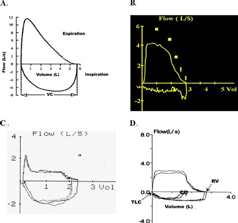 Flow-volume loop. Normal pattern (panel A), variable extrathoracic ...