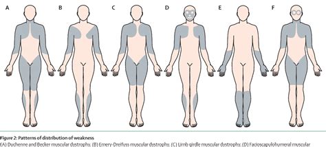 Patrones De Debilidad De Las Enfermedades Musculares Neuropediatoolkit