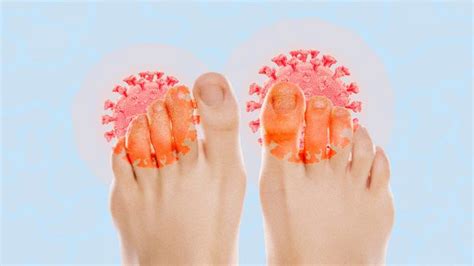 Are 'COVID Toes' a Real Symptom of the Virus?