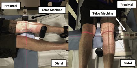 At The 6 Week Follow Up Appointment A Telos Machine Is Used To Provide Download Scientific