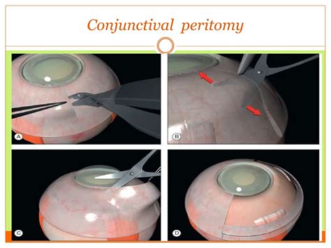 RETINAL DETACHMENT SURGERY 2.pptx