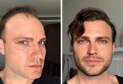 Hair Transplant Before And After Transforming Lives