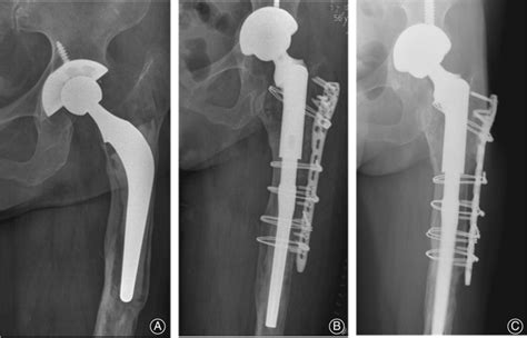 Radiographs Of A 56yearold Woman Who Underwent Hip Revision 4 Years