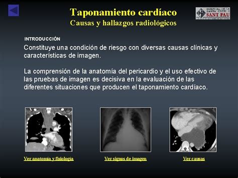 Taponamiento Cardaco Causas Y Hallazgos Radiolgicos Alberto Hidalgo