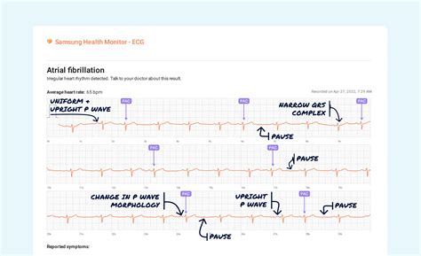 Premature Atrial Contraction Multiple Vs Atrial Fibrillation On Your