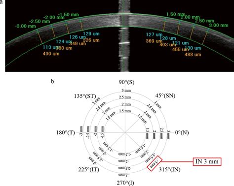 A Anterior Segment Optical Coherence Tomography Image The Blue Value