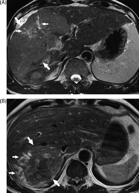 Comparison Of Diffuse Hepatocellular Carcinoma And Intrahepatic Cholangiocarcinoma Using