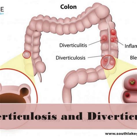 Diverticulitis Surgery at Southlake General Surgery | Diverticulitis ...