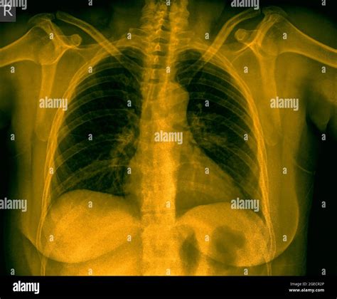 Radiografia Del Torace Immagini E Fotografie Stock Ad Alta Risoluzione