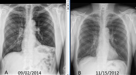 Figure Chest X Ray Showing Elevated StatPearls NCBI Bookshelf