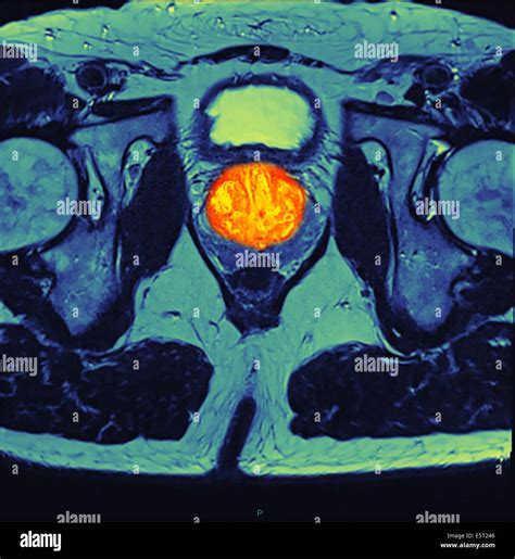 Prostate cancer mri hi-res stock photography and images - Alamy