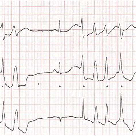 Rhythm Strip Showing Sinus Bradycardia And Short Runs Of Torsades De