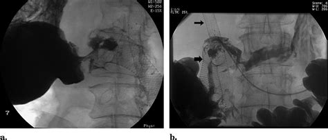 Transhepatic Assisted Transoral Placement Of A Duodenal Stent In Malignant Gastric Outlet