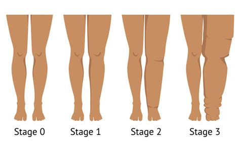 Lipedema And Lymphedema Treatment Nmvs