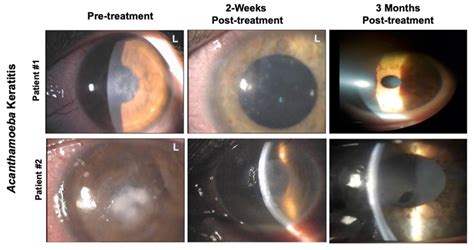 Representative Pictures Of Two Patients Affected By Acanthamoeba Download Scientific Diagram