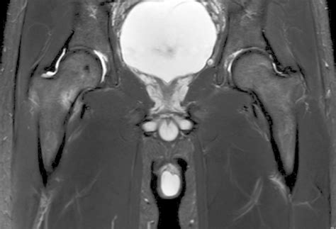 Femoral Neck Archives OrthoBuzz