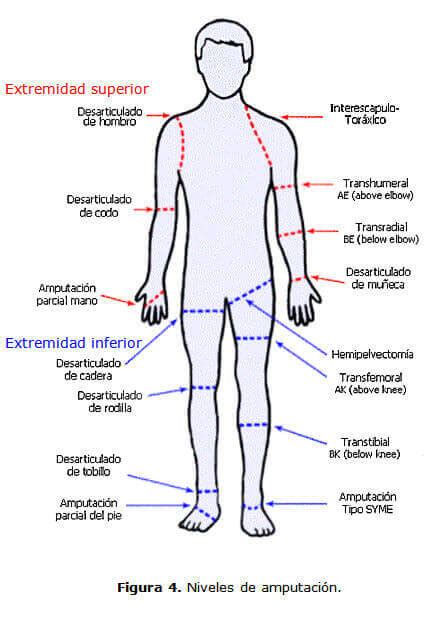 Conociendo Las Amputaciones En La Infancia