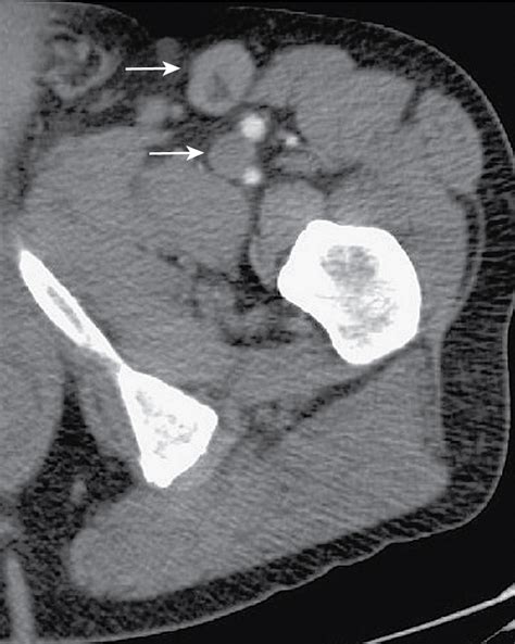 Lymphadenopathy Radiology Key