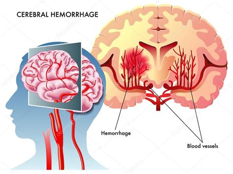 Pictures Circle Of Willis Cerebral Hemorrhage — Stock Vector © Rob3000 59877961