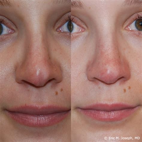 Eric M Joseph Md Permanent Non Surgical Rhinoplasty Nose Job