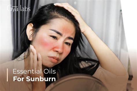 14+ Amazing Essential Oils To Treat Sunburn