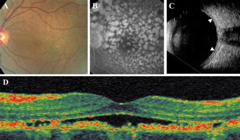 Paraneoplastic And Related Retinopathies