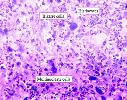 Giant Cell Histology