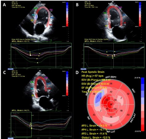 An Example Of Echocardiographic Speckle Tracking Strain Analysis