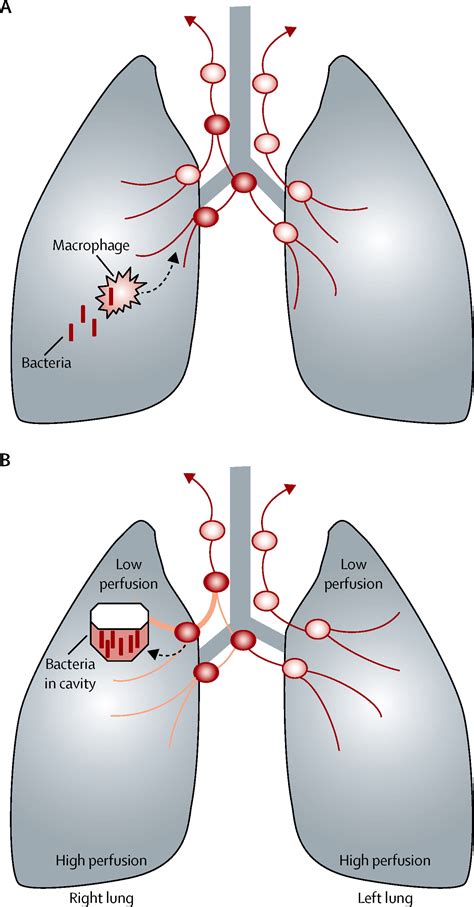 References In Is Tuberculosis A Lymphatic Disease With A Pulmonary