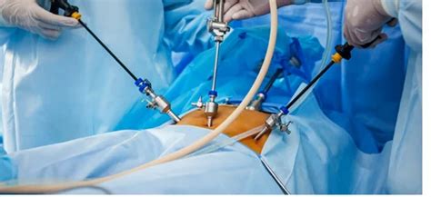 Laparoscopic Surgery Iran Laparoscopy Surgery Cost Iran Iranian Surgery