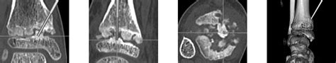 Resection Of A Physeal Bar Under Computer Assisted Guidance Bone Joint