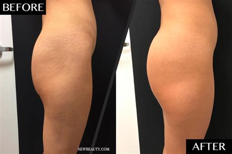 Emsculpt Vs Sculptra For Non Surgical Buttocks Augmentation