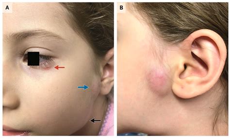 Parinauds Oculoglandular Syndrome A Case In An Adult With Flea Borne