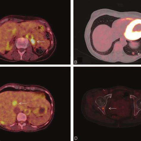 Transaxial 18 F FDG PET CT At The Level Of The Abdominal Aorta