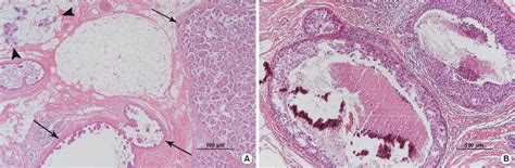 Figure 1 From Invasive Micropapillary Carcinoma In Axillary Ectopic