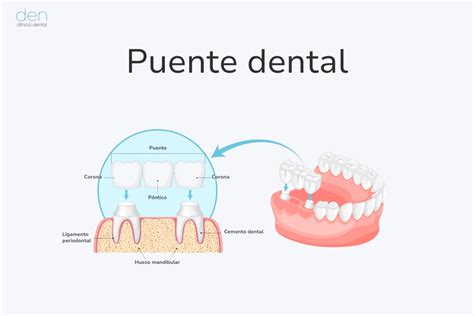 ¿qué Es Un Puente Dental Y Qué Tipos Hay