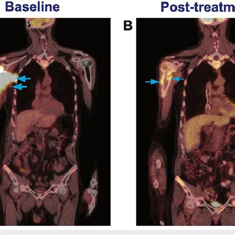 PET scan images (A) Initial staging PET scan. There is marked FDG ...