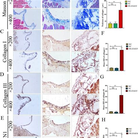 Lgals Promotes Peritoneal Metastasis Of Gc Through Peritoneal