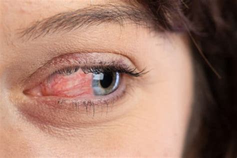 Ocular Rosacea: Treatment, Symptoms, & Causes | Michigan Eye Institute