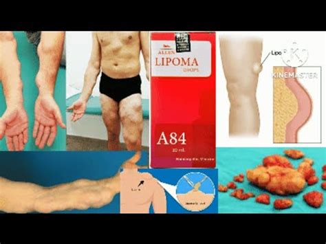 Homoeopathic Medicine For Lipoma Charbi Ki Ganth Ka Ilaz Allen A84