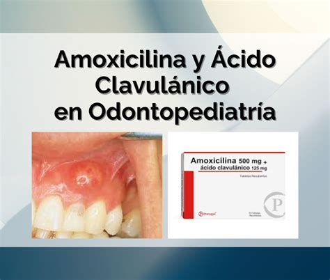 Dor De Dente Rosto Inchado Amoxicilina - ¿Cuántos Días Tomar Amoxicilina para una Infección Dental? Guía ...
