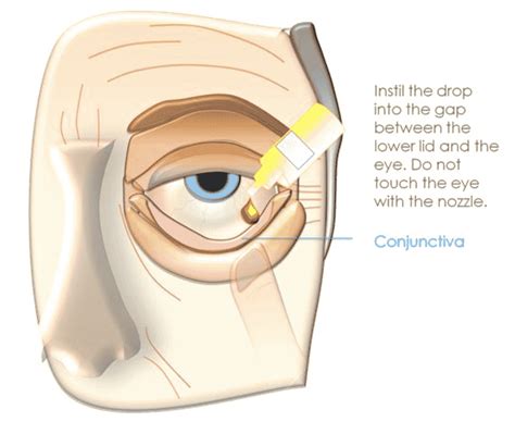 Blepharitis And Meibomitis Conditions And Treatments Clinica London