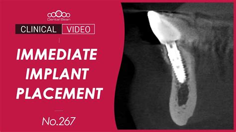 42 Immediate Implant Placement After Extraction Dr Jeon Inseong