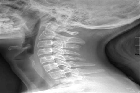 xray-neck - Reno Family Chiropractic