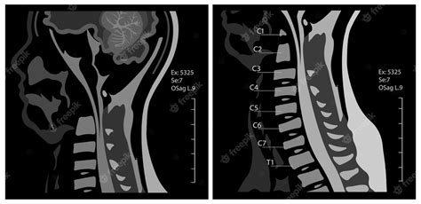 Premium Vector Magnetic Resonance Image Or Mri Of The Cervical Spine