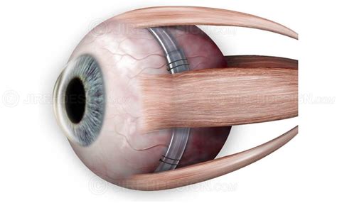 Scleral buckle RD treatment - #SUVR0032 | Stock eye images