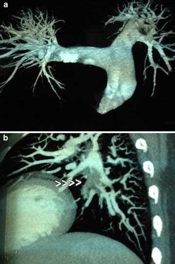 Ct Pulmonary Angiography Showing Thrombus B Ct Pulmonary Angiogram Download Scientific Diagram