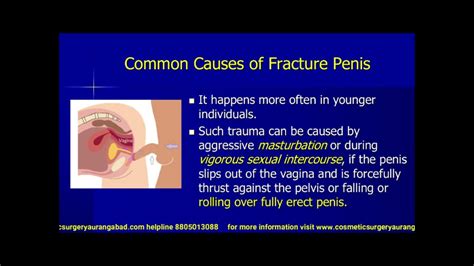 Penis Fracture Reconstructive Plastic Surgery Repair With Good Erectile Function And Cosmetic